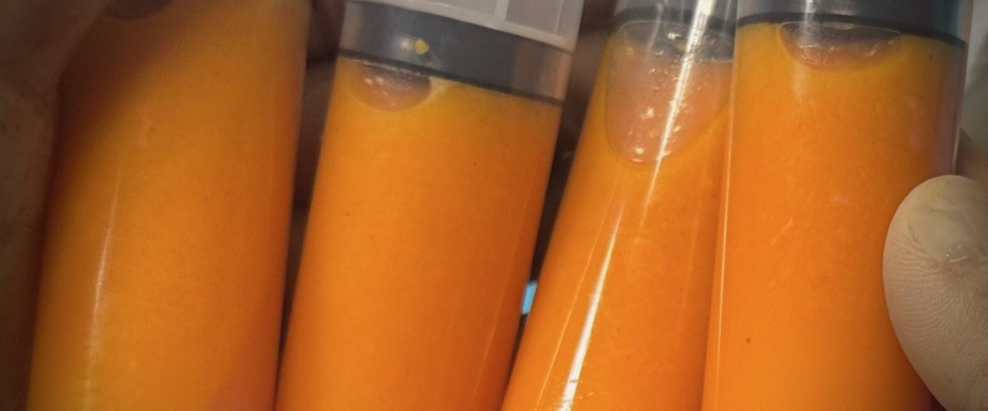 Syringes of processed fat, prepared for grafting